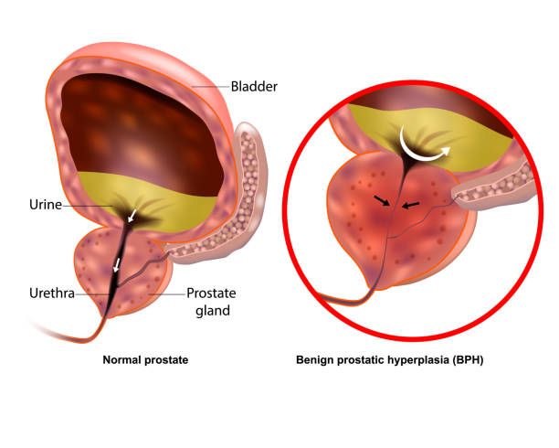 Enlarged Prostate Gland Treatment in Iran