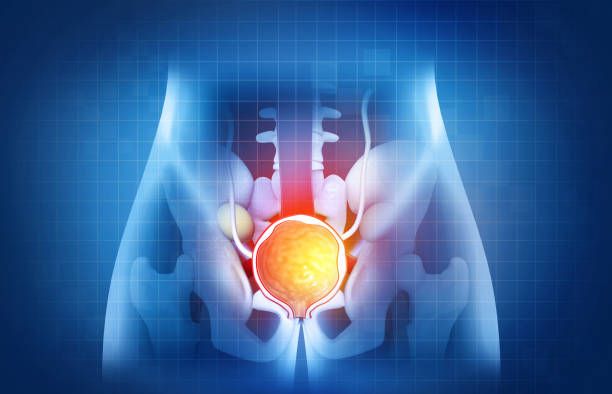 Enlarged Prostate Gland Treatment in Iran