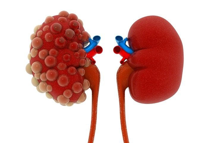 Signs of Chronic Kidney Disease