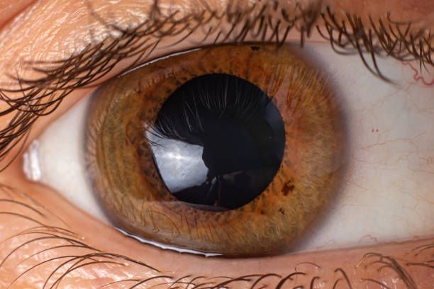 Cornea Transplant in Iran