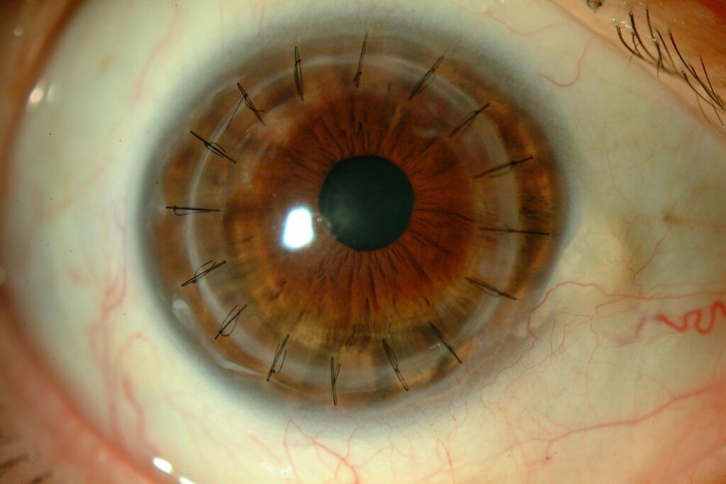 What is a Cornea Transplant? 