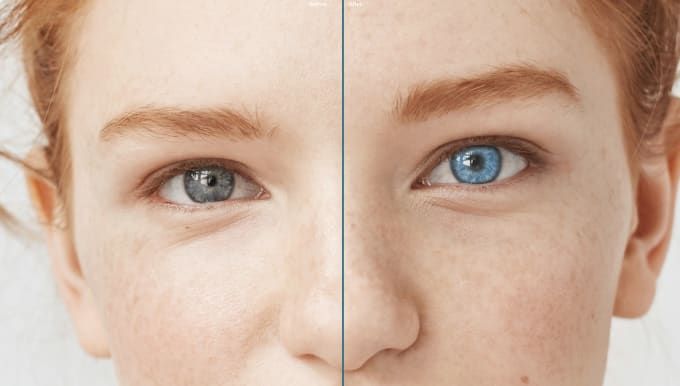 About Eye Color Change Surgery