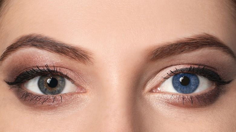 Eye Color Change Surgery in Iran