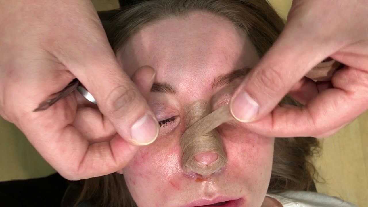 Nose Taping After Rhinoplasty