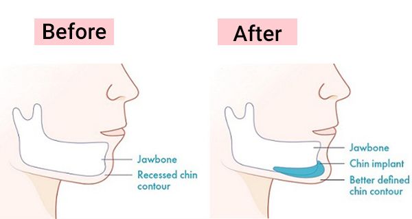 Who gets chin implants?