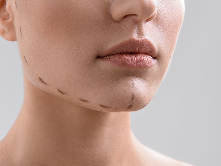 Risks of a chin implant