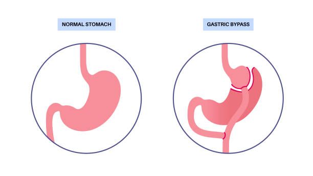 What is Gastric Bypass?