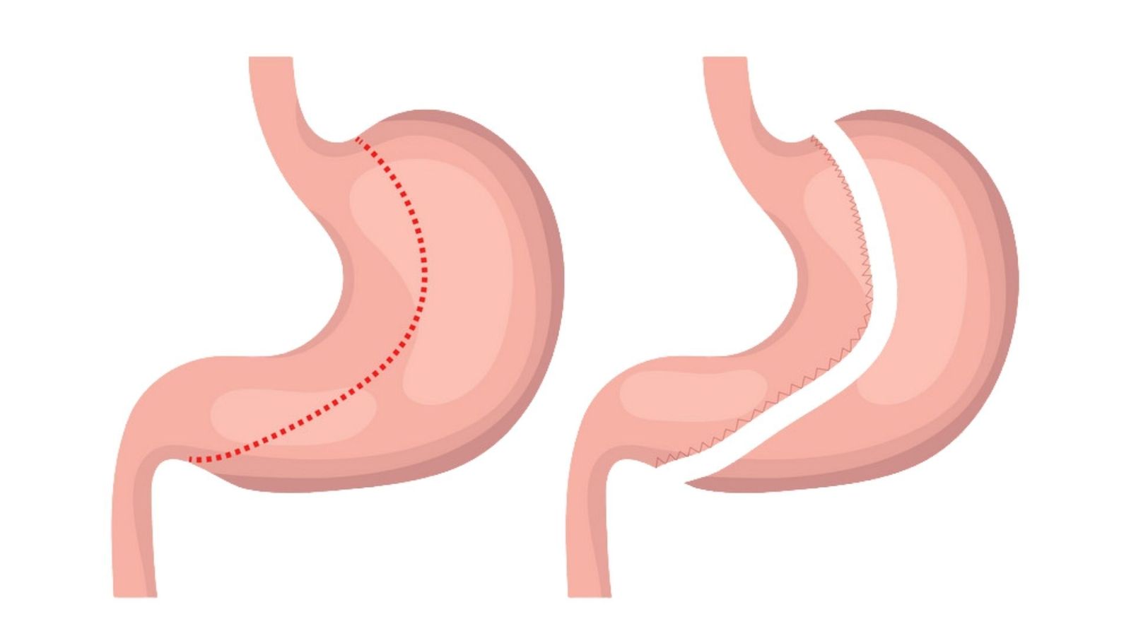 What is a Gastric Sleeve?