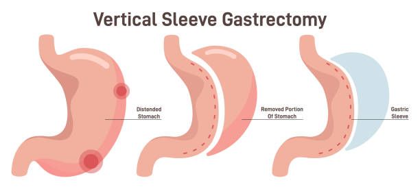 Gastric Sleeve Pros & Cons