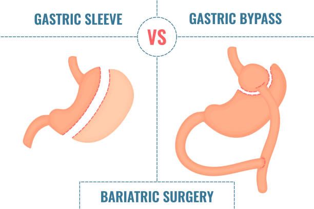 Gastric Bypass vs. Gastric Sleeve