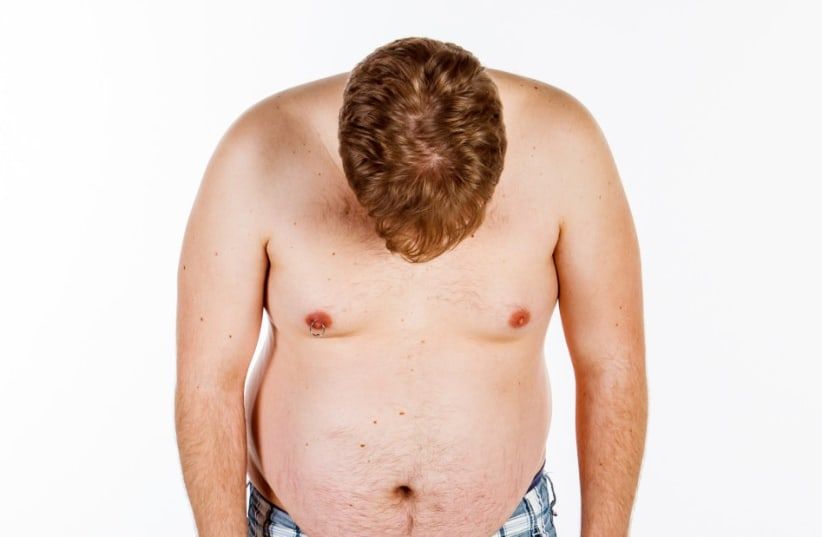 The Difference Between Gynecomastia and Pseudogynecomastia