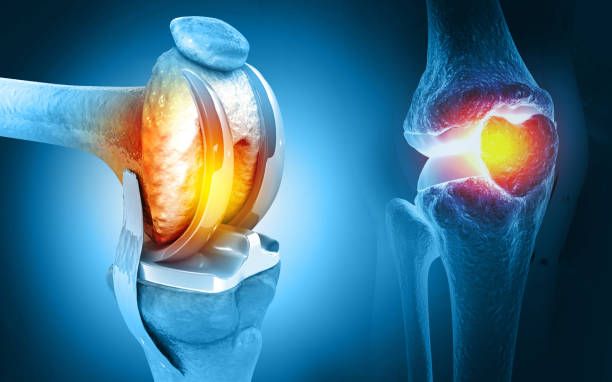 What is Total Knee Replacement?