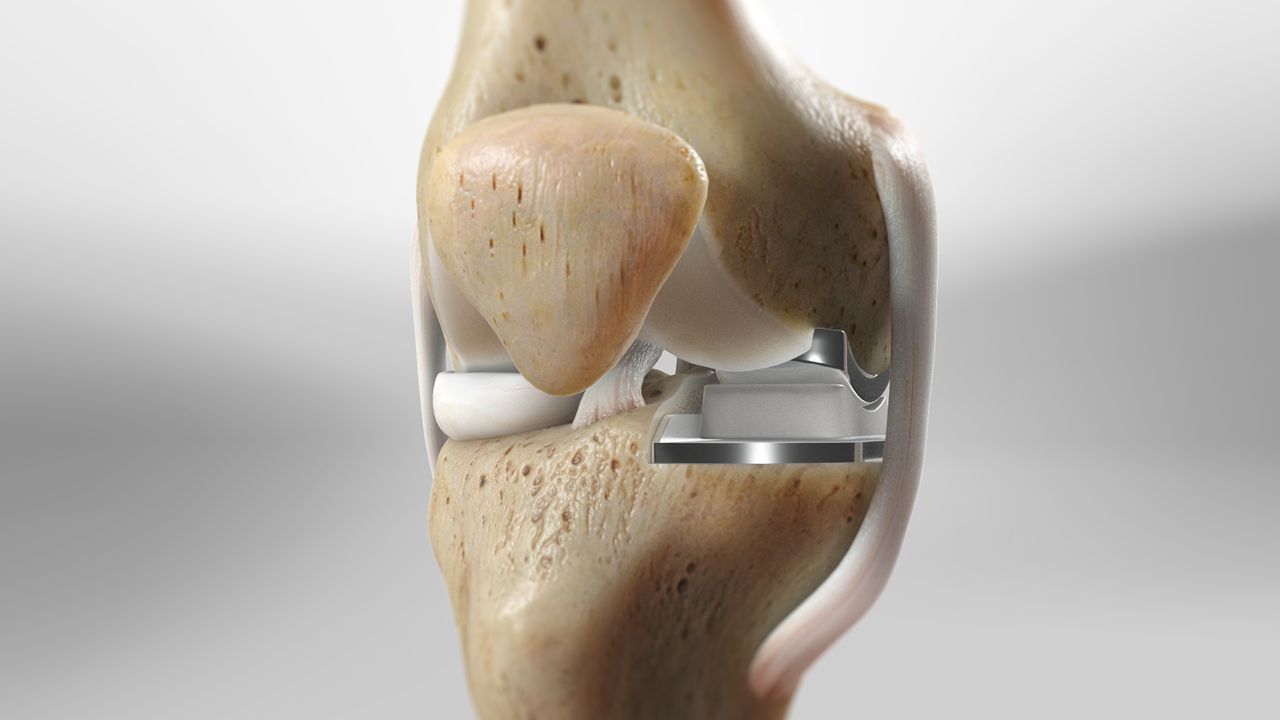 What is Partial Knee replacement?