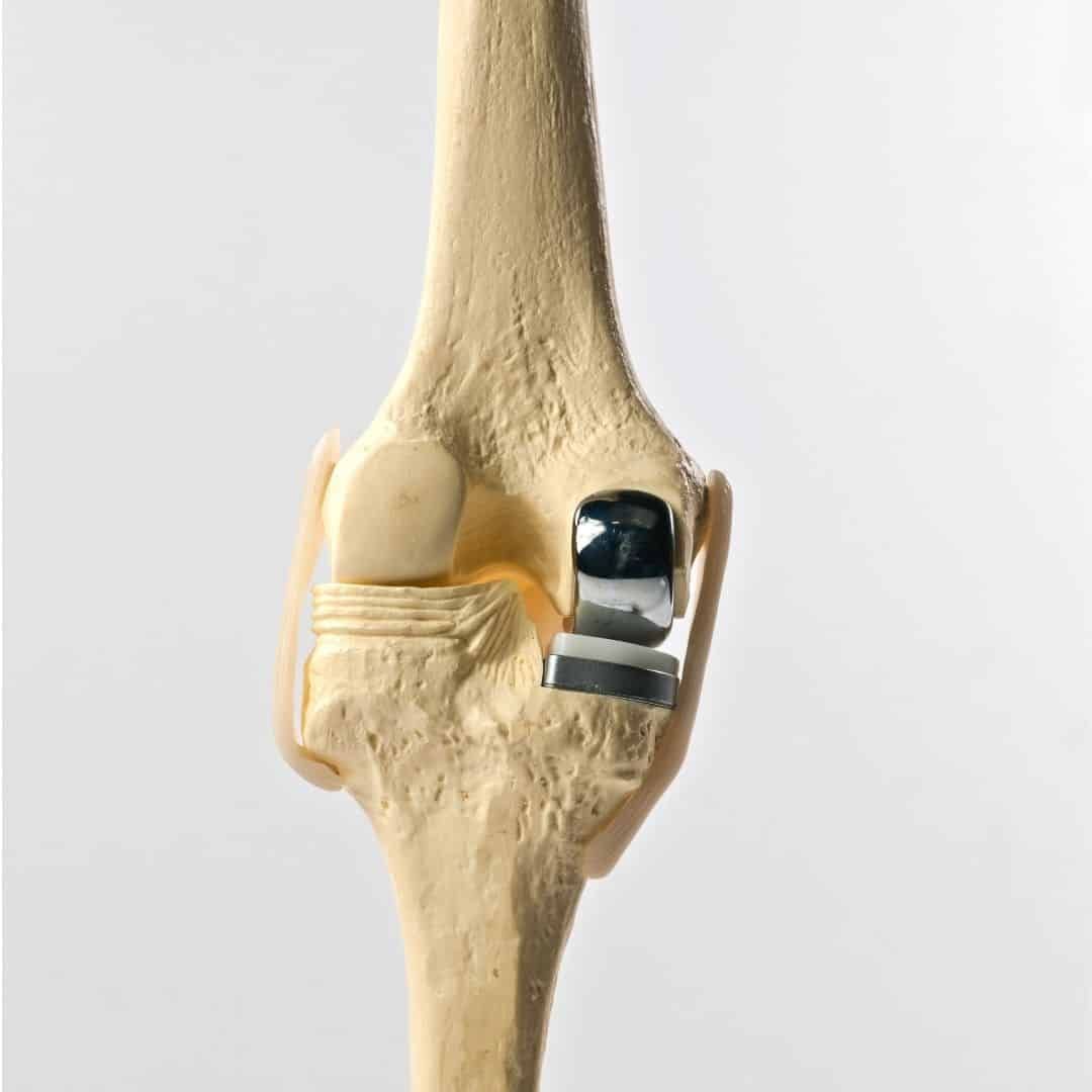 Benefits and Risks of Partial Knee Replacement