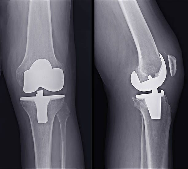 Benefits and Risks of Total Knee Replacement