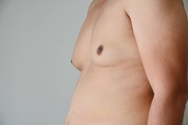 What is Gynecomastia?