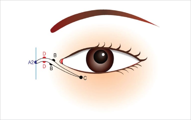 Epicanthoplasty