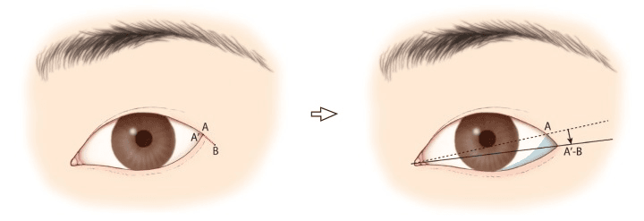 Lateral Canthoplasty