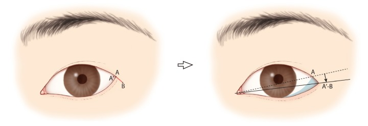 Lateral Canthoplasty