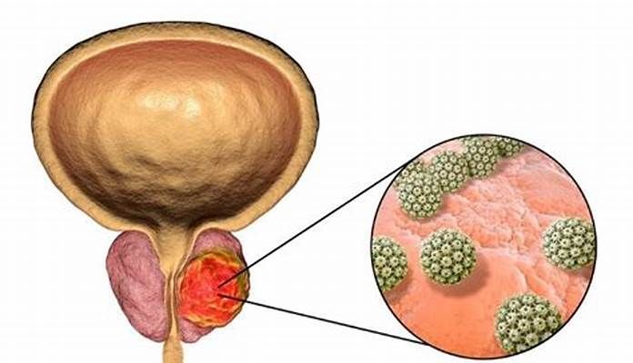 What are the different types of Prostate Surgery?