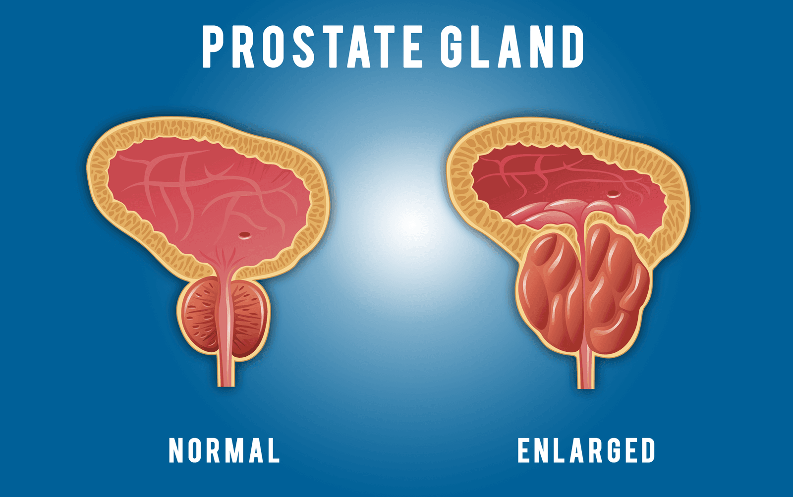 Prostate Surgery Cost in Iran