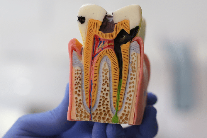 When is Root Canal Treatment needed?