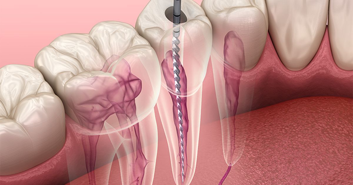 Apicoectomy treatment procedure