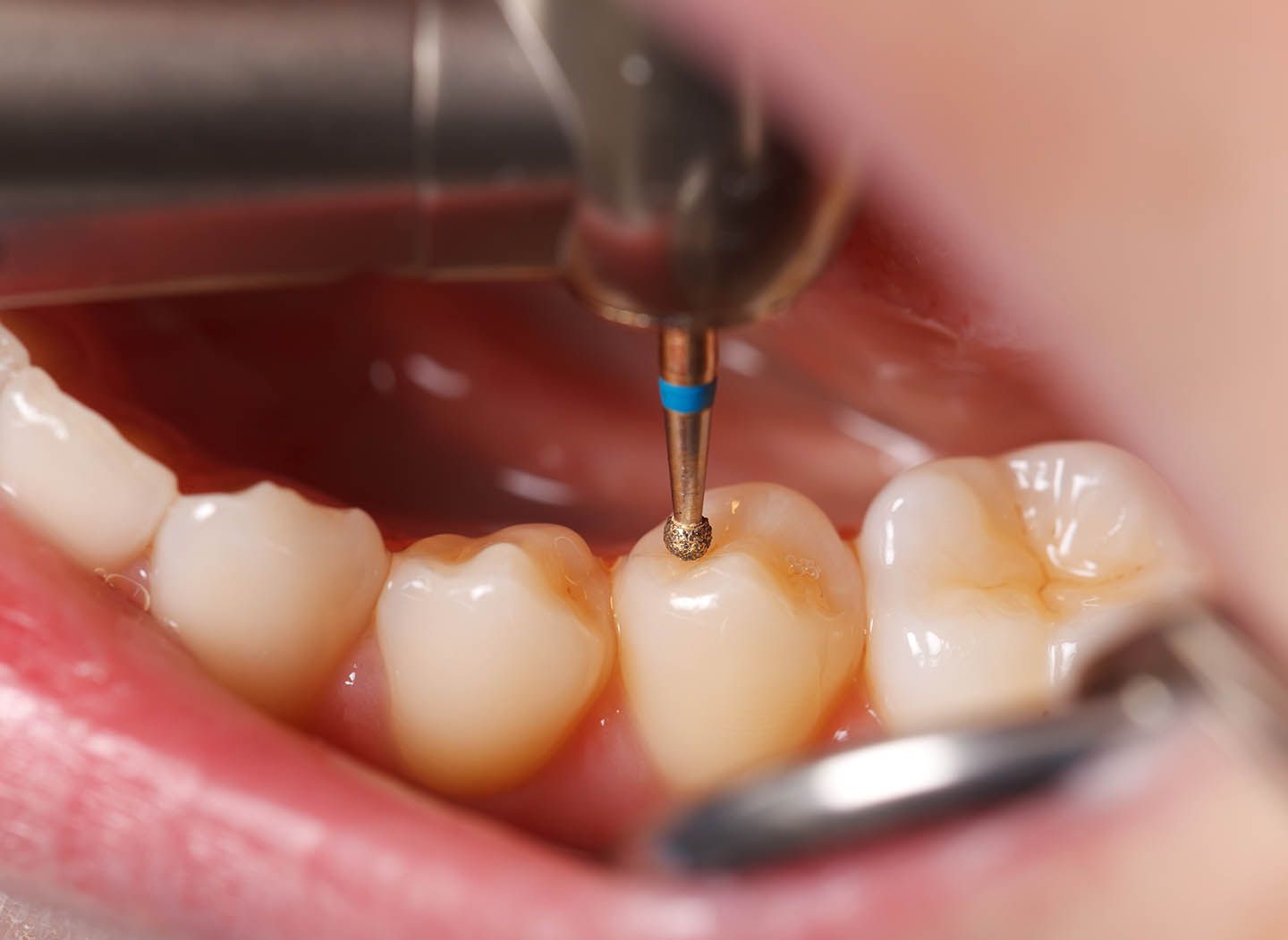 Before and During Endodontic Therapy