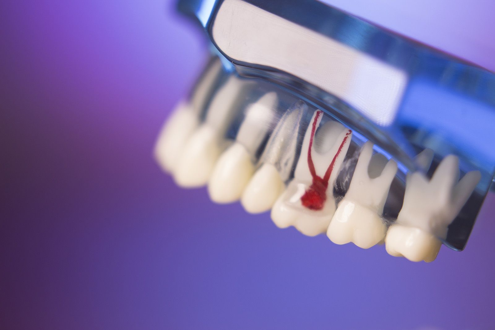 Side effects and risks of Endodontic Therapy