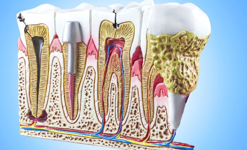 Endodontic Therapy Aftercare and Recovery