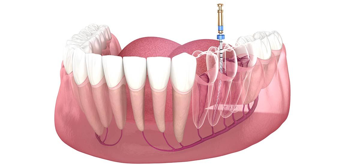 Root Canal Treatment Cost in Iran