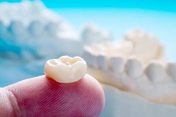 What Is a Dental Cap?