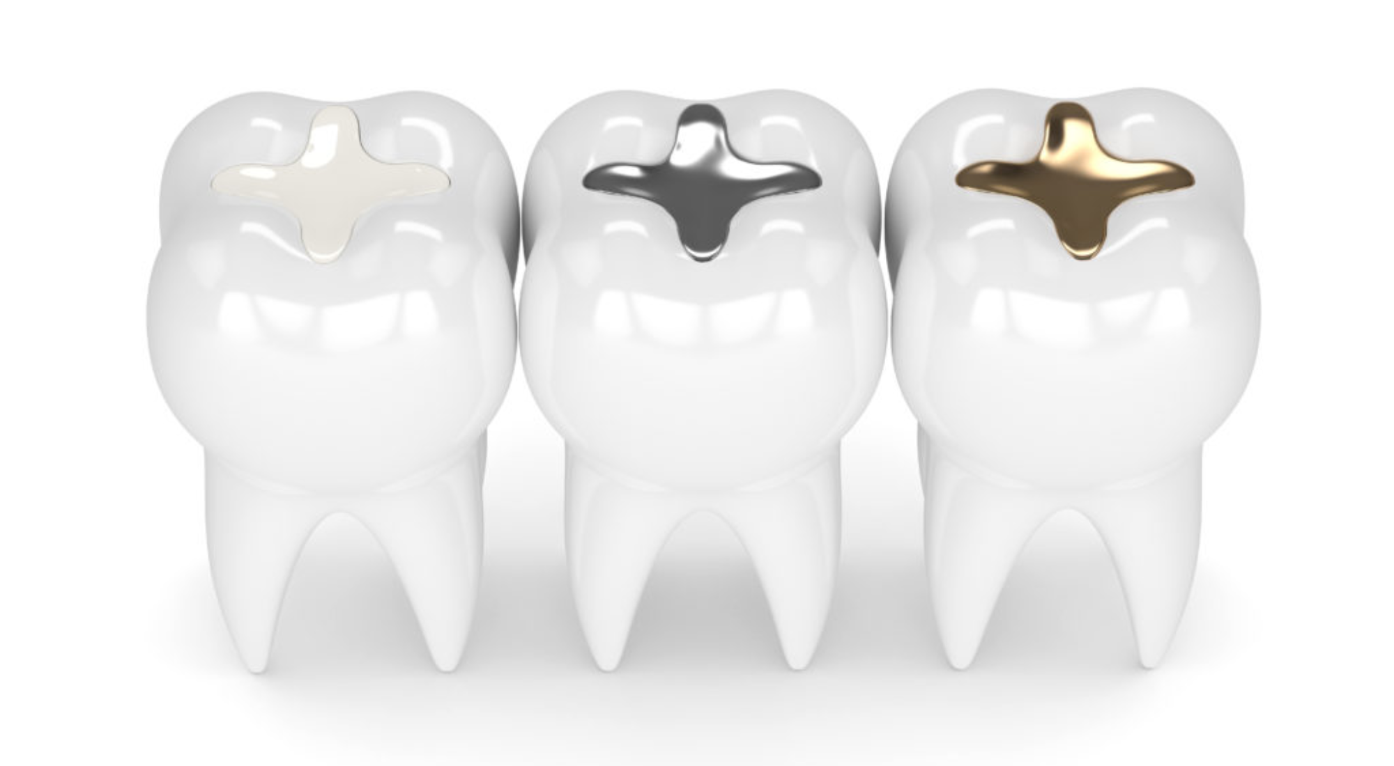 Composite vs. Amalgam Fillings