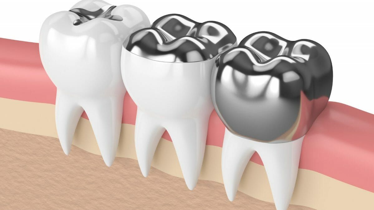 What is Amalgam Filling?