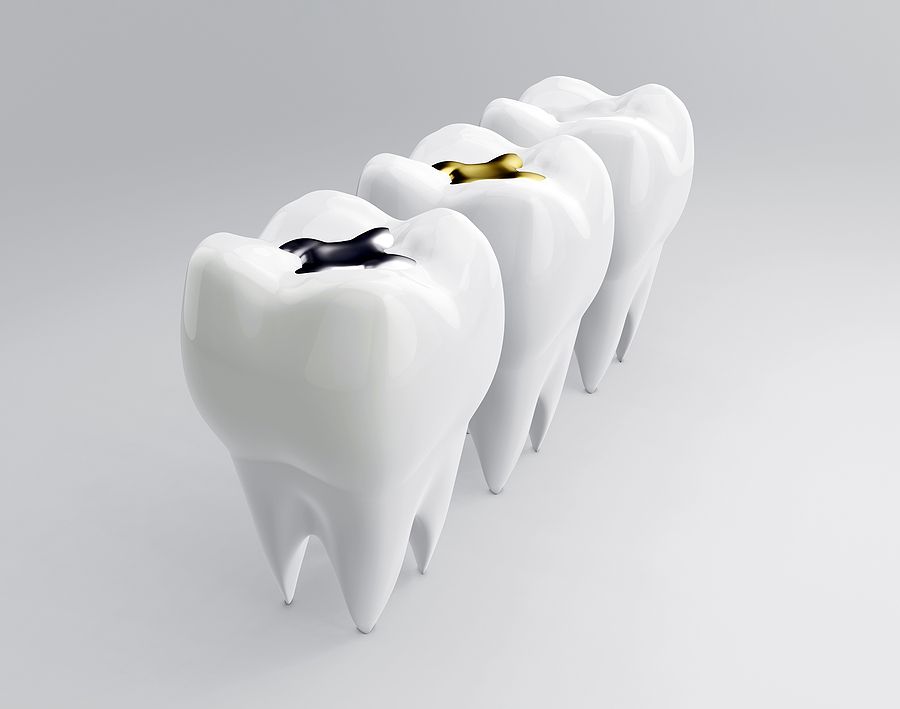 Advantages and Disadvantages of Amalgam Fillings