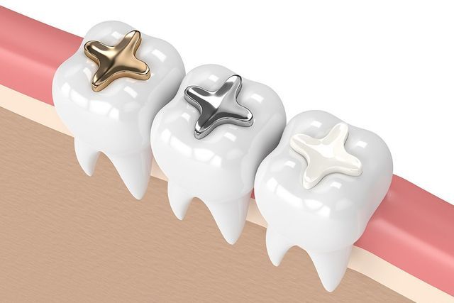 Advantages and Disadvantages of Composite Fillings