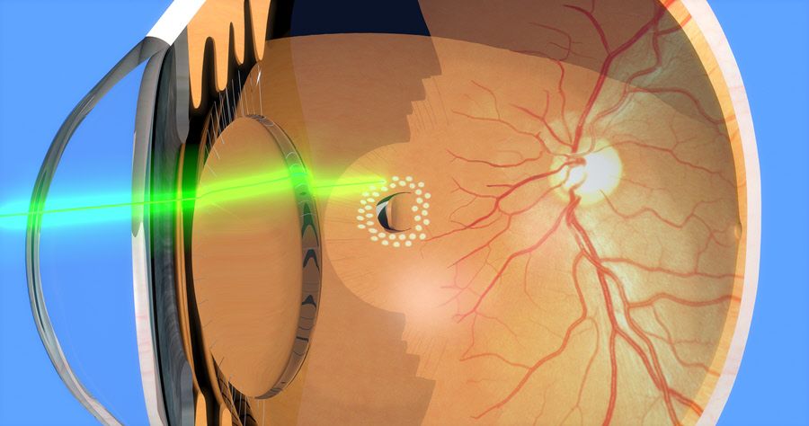 Pan Retinal Photocoagulation