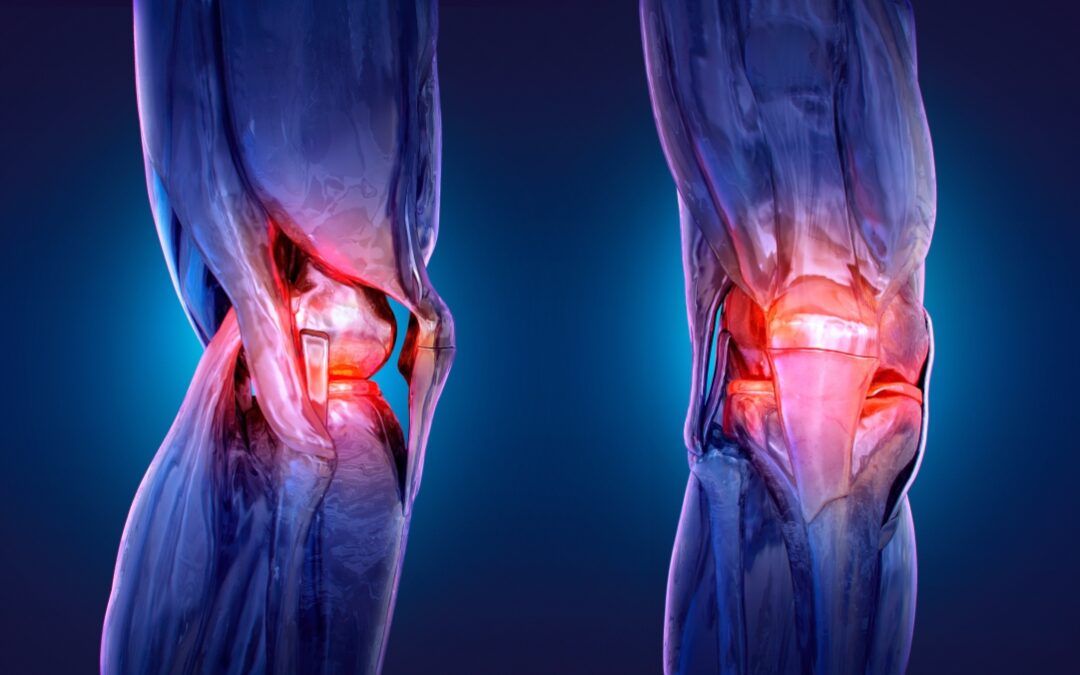 Robotic vs. Traditional Knee Replacement