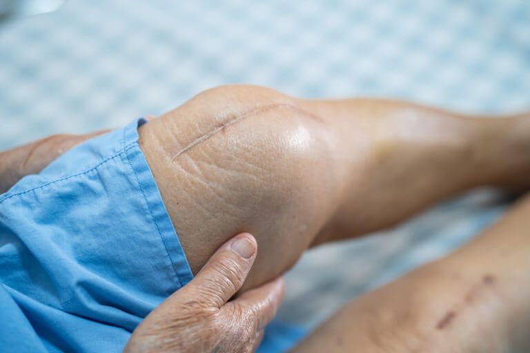 What is total knee replacement surgery?