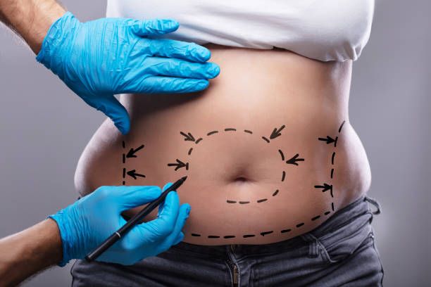 Liposuction Recovery tips