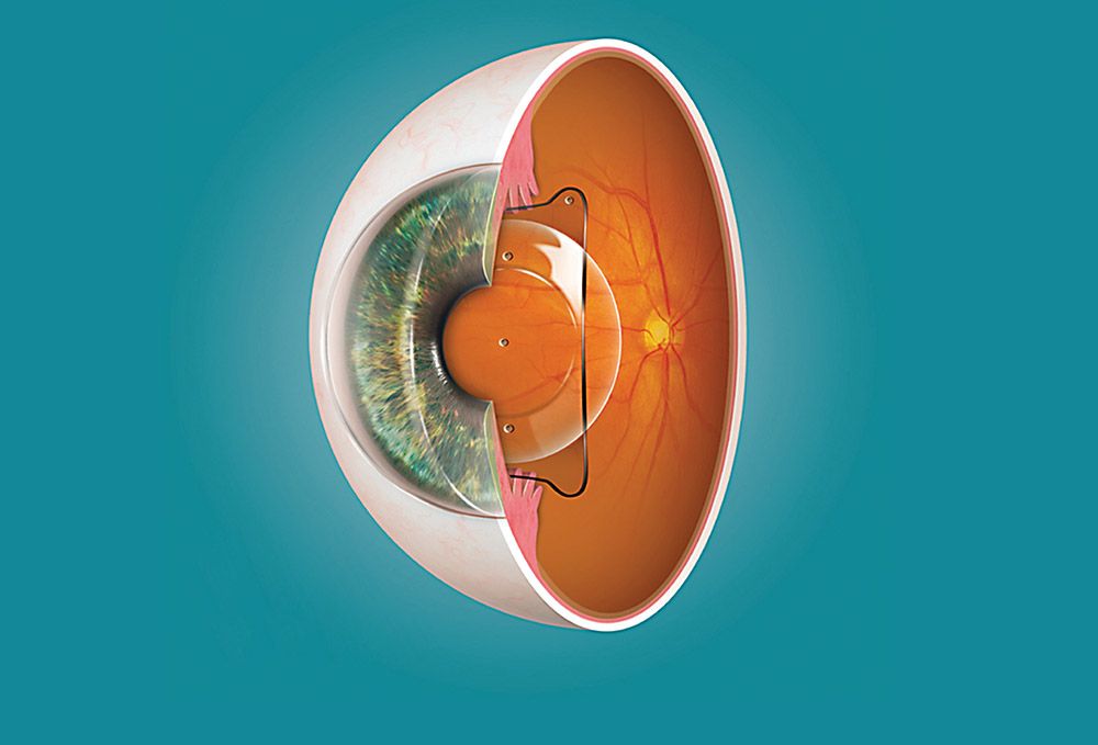 Implantable collamer lenses