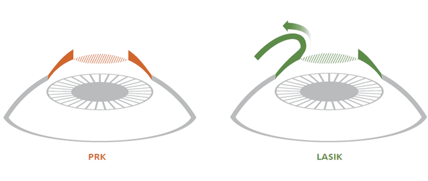 The difference between LASIK and PRK