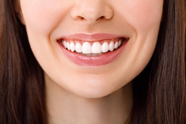 What is a Hollywood smile?