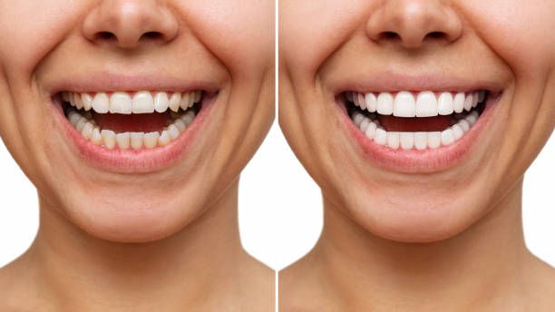 Hollywood smile vs. veneers