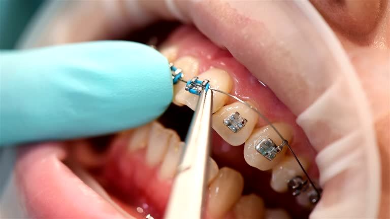 Stages of an Orthodontic Treatment