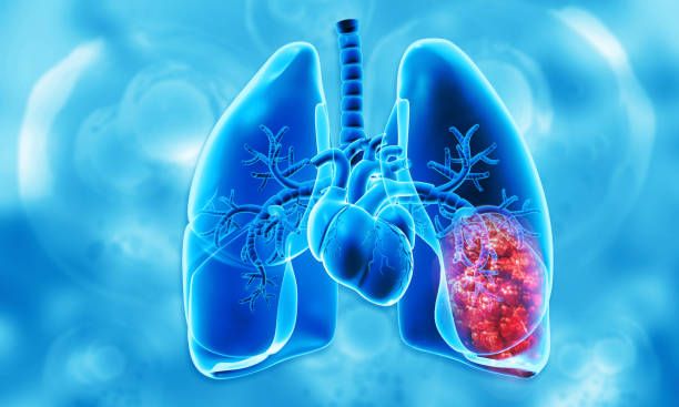 The risks of Lung Transplant