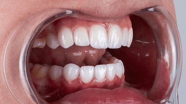 Dental bonding vs. veneers