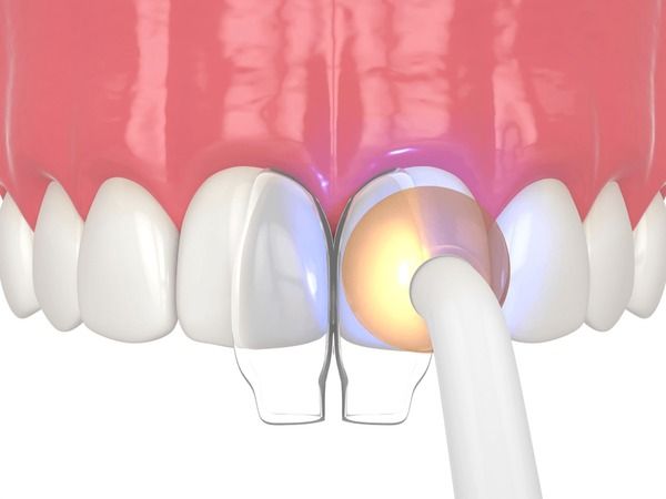 What happens before, during and after Dental Bonding?