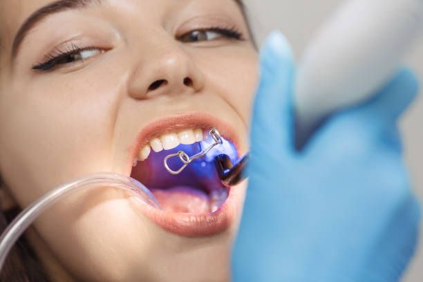 Dental Bonding cost in Iran