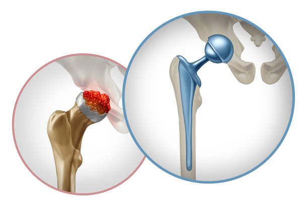 What is Joint replacement used for?